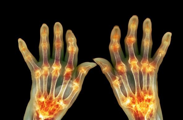 Rheumatoid Arthritis