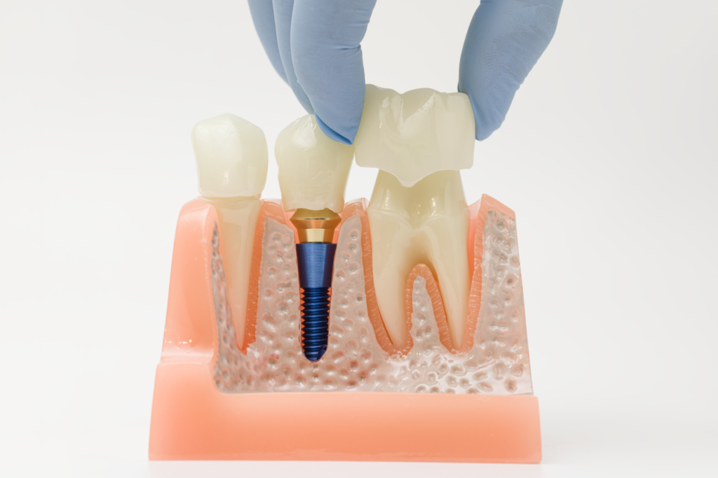 dental veneers and crowns