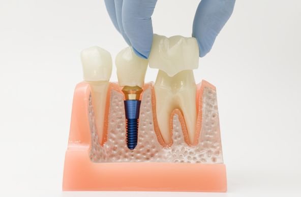 dental crowns